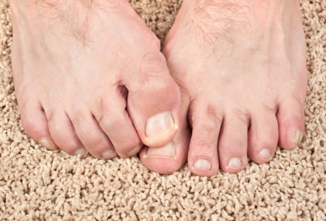 How to prevent toenail fungus?