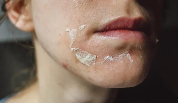 Chemical Peel Aftercare Chemical Peel Aftercare